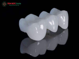 Cầu răng sứ răng cửa có nên làm không? Lưu ý khi làm cầu răng sứ răng cửa