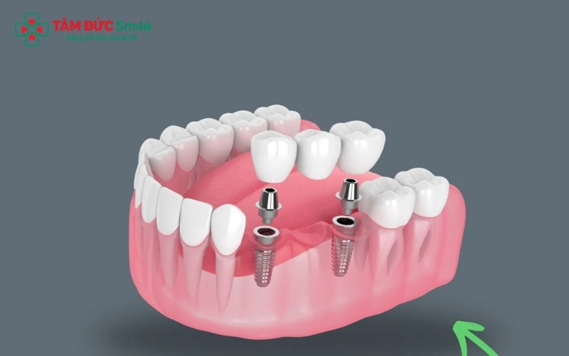 Cầu răng sứ Titan có cấu tạo gồm khung sườn làm từ hợp kim chứa tinh chất Titan phi từ tính và lớp sứ thẩm mỹ bao phủ bên ngoài.