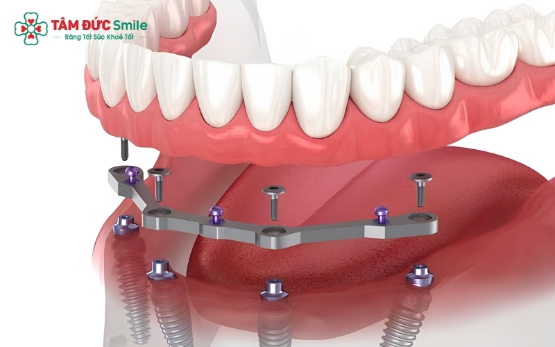 Cầu răng sứ Titan thường được ưu tiên cho các vị trí răng hàm do khả năng chịu lực tốt và chi phí hợp lý hơn so với răng toàn sứ.
