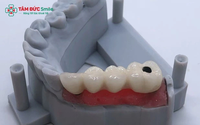 Với độ bền cơ học cao, cầu răng sứ Titan giúp khôi phục khả năng ăn nhai gần như răng thật, đảm bảo lực nhai ổn định