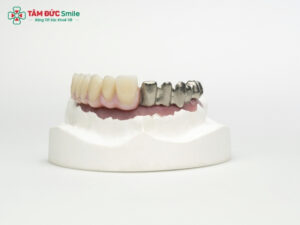 Cầu răng sứ Titan là gì? Cầu răng sứ Titan có tốt không?