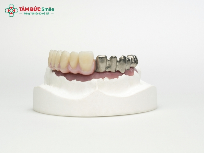 Cầu răng sứ Titan là gì? Cầu răng sứ Titan có tốt không?