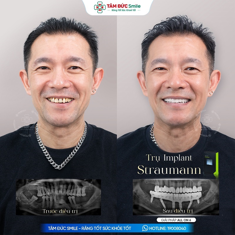 Khách hàng Trọng Thuần thực hiện Implant All-on-6 hàm dưới bằng trụ Straumann.