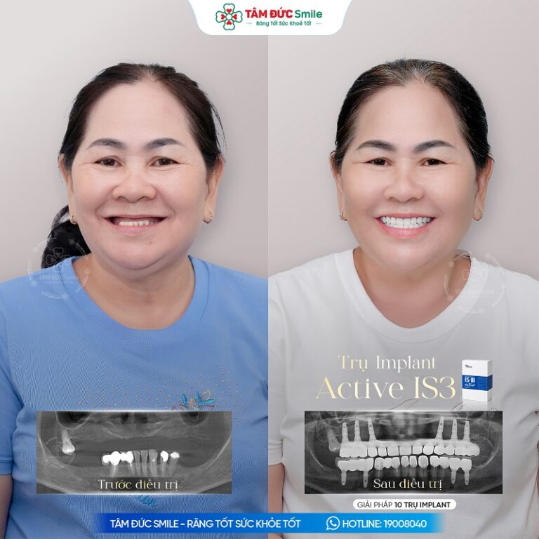 Khách hàng Thu Sương cấy ghép 10 trụ Implant Active IS3, kết hợp phục hình răng sứ.