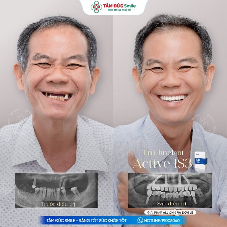 Khách hàng Thanh Sơn thực hiện Implant All-on-4 hàm trên và Implant đơn lẻ hàm dưới, kết hợp phục hình sứ toàn hàm.