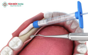 Cấy ghép xương để cắm Implant có mắc không?