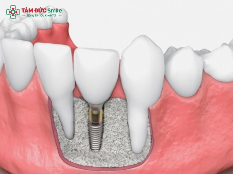 Chất lượng bột xương và các kỹ thuật phức tạp đi kèm như nâng xoang là những yếu tố then chốt quyết định tổng chi phí điều trị.