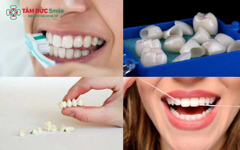 Cầu răng sứ có nhịp cầu nằm trên nướu, tạo ra khoảng hở nhỏ rất dễ tích tụ mảng bám và vi khuẩn nếu không được vệ sinh đúng cách.