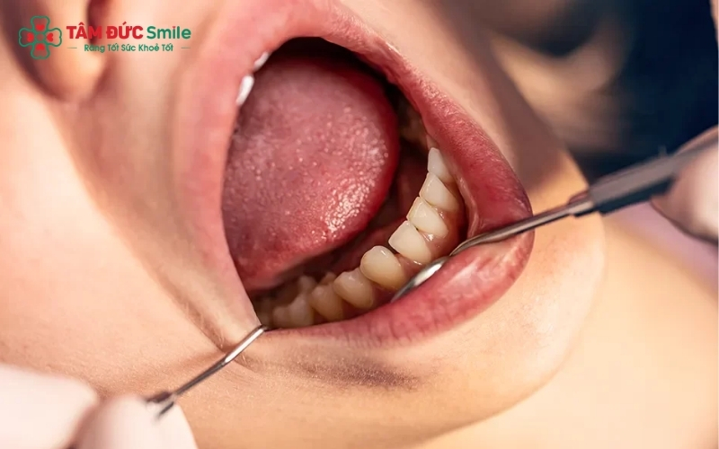 Khi xuất hiện dấu hiệu sưng nướu, hôi miệng hoặc đau nhức quanh răng trụ, bạn cần đến nha khoa ngay để tránh biến chứng hỏng răng trụ thật.