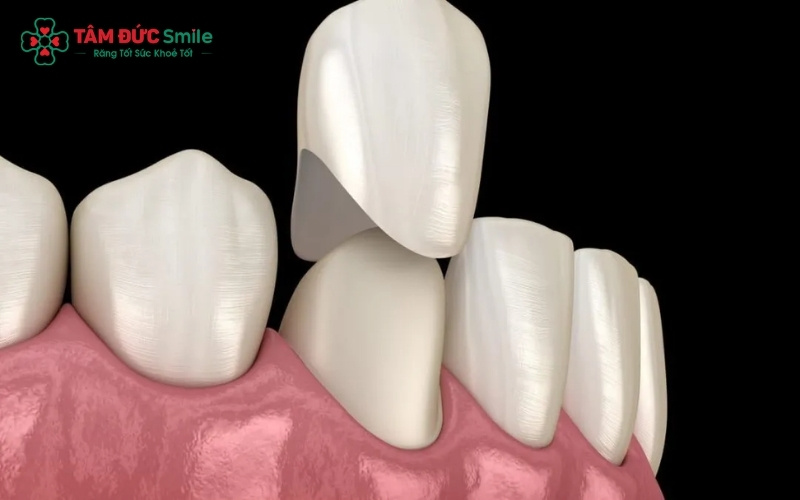 Cùi răng đóng vai trò là trụ cột quan trọng, giúp nâng đỡ và cố định mão răng sứ vững chắc trên cung hàm.