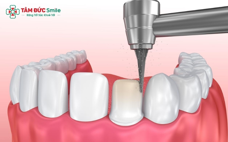 Mài cùi răng được chỉ định khi răng bị hư tổn, sâu hỏng hoặc khuyết điểm thẩm mỹ để chuẩn bị cho bước bọc sứ sau đó.