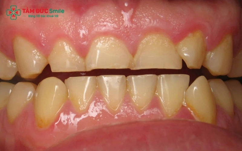 Với những răng bị vỡ lớn hoặc chỉ còn chân răng, bác sĩ sẽ thực hiện làm cùi răng giả (chốt răng) để tạo trụ bám cho răng sứ.