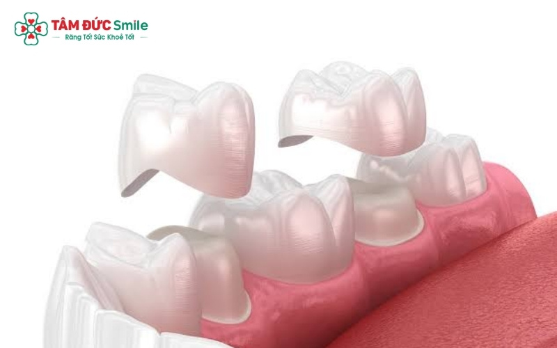 Cùi răng giả giúp bảo tồn tối đa chân răng thật, tuy nhiên cần lựa chọn vật liệu phù hợp để đảm bảo tính thẩm mỹ và độ bền.