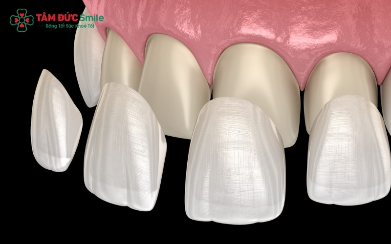Dán sứ Veneer không chỉ mang lại vẻ đẹp tự nhiên mà còn có tuổi thọ lên đến 15-20 năm nếu chăm sóc đúng cách.