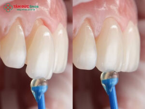 Dán răng sứ có bền không? Tuổi thọ, yếu tố ảnh hưởng và cách chăm sóc