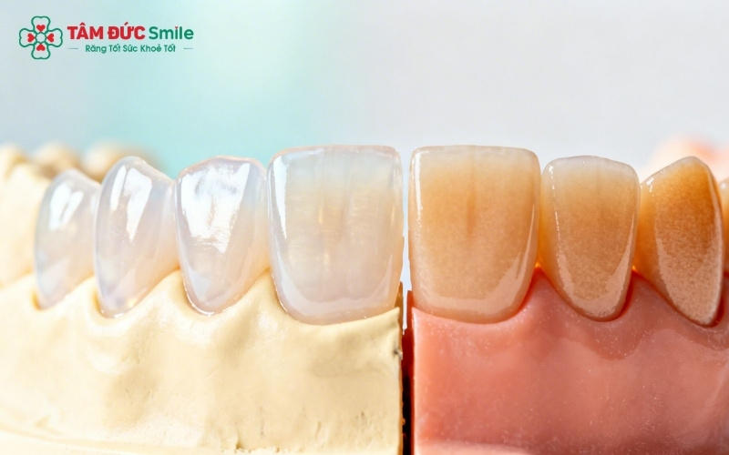 Tùy vào tình trạng răng khỏe hay hư tổn nặng mà bác sĩ sẽ chỉ định dán sứ hoặc bọc sứ để đảm bảo độ bền tối ưu.