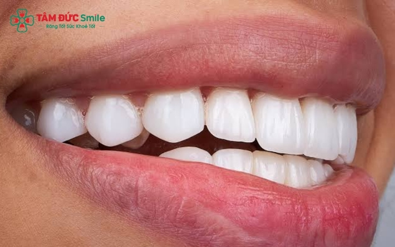 Dán răng sứ Veneer là kỹ thuật xâm lấn tối thiểu, cực kỳ an toàn khi được thực hiện đúng quy trình nha khoa.