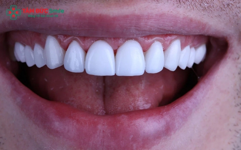 Các biến chứng như viêm nướu, hôi miệng thường xuất phát từ việc mặt sứ không sát khít hoặc vệ sinh kém.