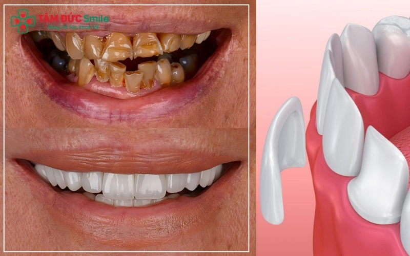 Sử dụng vật liệu chính hãng và tuân thủ hướng dẫn của bác sĩ là chìa khóa cho nụ cười đẹp bền vững.