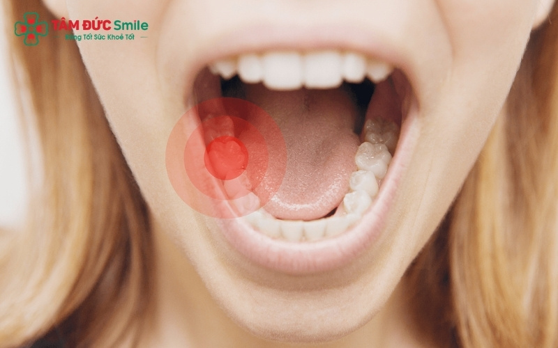 Cơn đau răng sâu có thể diễn ra từ ê buốt thoáng qua đến đau nhức dữ dội kéo dài nhiều ngày,