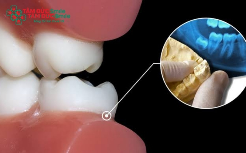 Đau răng sâu kéo dài là dấu hiệu vi khuẩn đã tấn công vào tủy; nếu không điều trị sớm, nguy cơ áp xe chân răng và nhiễm trùng xương hàm là rất cao.