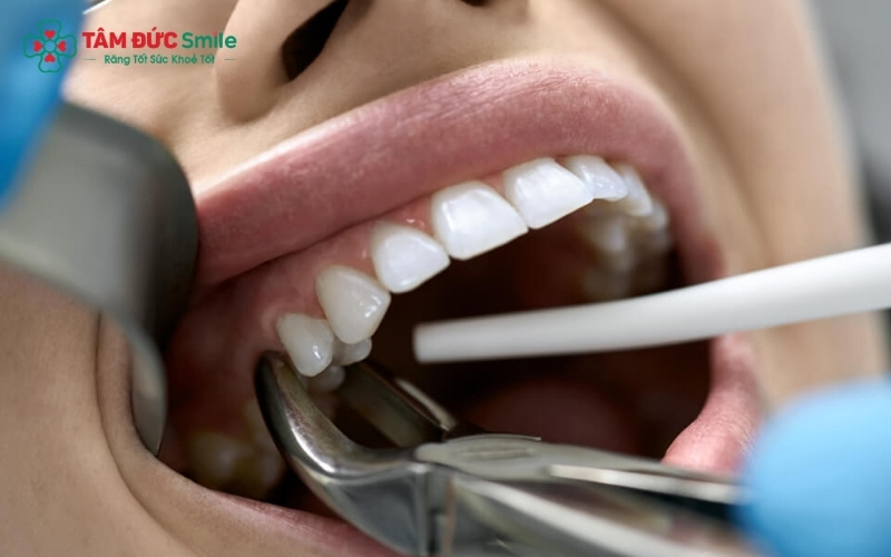 ùy vào mức độ tổn thương, bác sĩ sẽ chỉ định trám răng thẩm mỹ hoặc điều trị tủy dứt điểm để loại bỏ hoàn toàn cơn đau và bảo tồn răng thật.