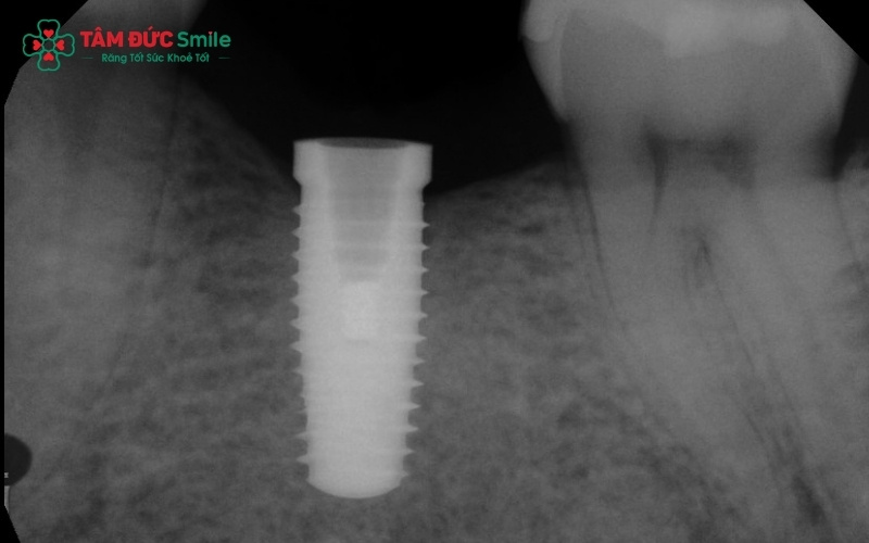 Cấu trúc kết nối giữa trụ Implant và mão sứ thông qua vít Abutment