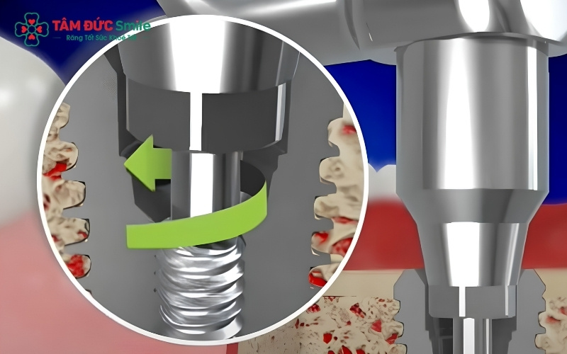 Bác sĩ phát hiện tình trạng vít bị đứt gãy bên trong lòng trụ Implant, từ đó đánh giá nguy cơ viêm nhiễm hoặc ảnh hưởng đến xương hàm.