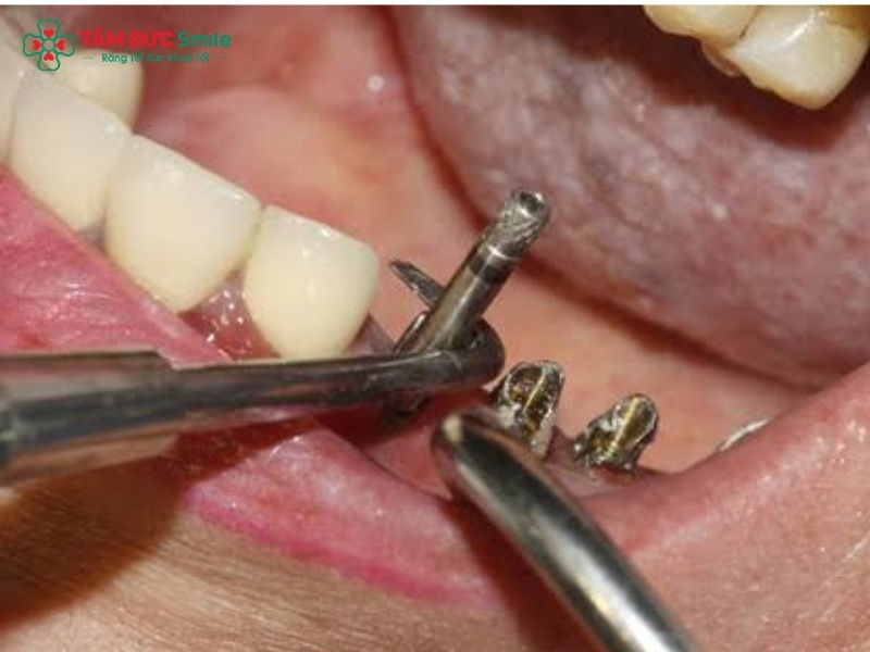 Gãy vít Abutment Implant: Nguyên nhân, ảnh hưởng và cách xử lý