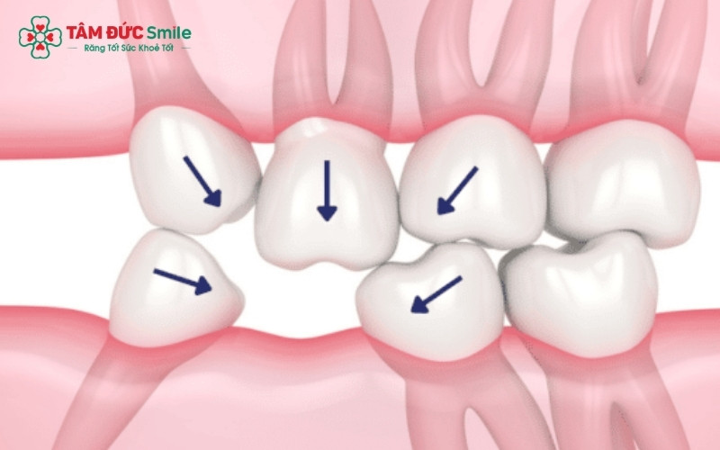 Kéo răng khôn là giải pháp tối ưu giúp bạn sở hữu lại hàm răng ăn nhai bằng chính răng thật của mình mà không cần cấy ghép Implant.
