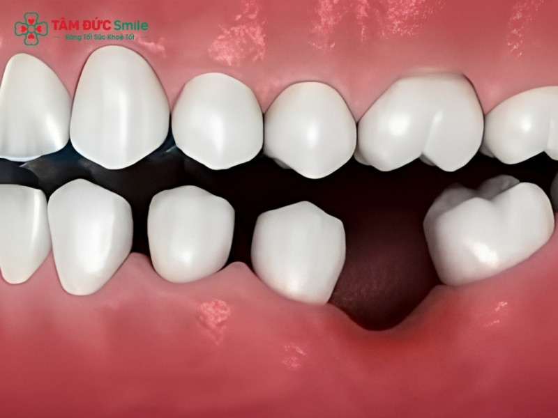 Kéo răng khôn thành răng số 7 được không? Điều kiện để kéo răng khôn thay răng số 7