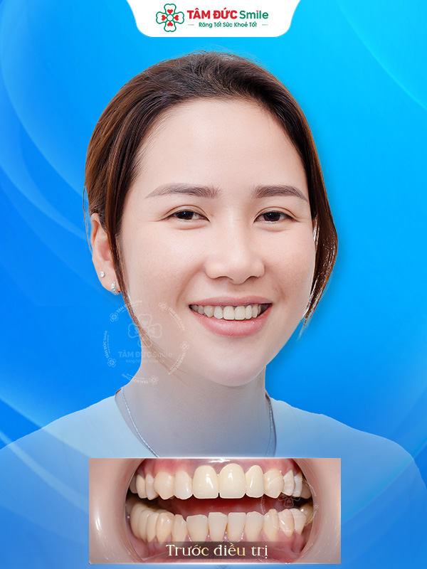 Ảnh sau