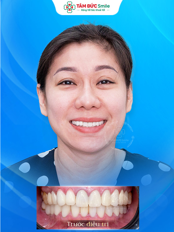 Ảnh sau
