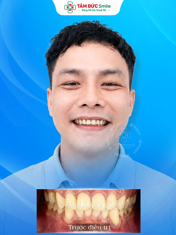 Ảnh sau