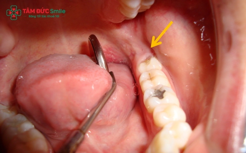 Hầu hết các loại thuốc tê dùng trong nha khoa đều an toàn và ít ảnh hưởng đến thai nhi hơn các loại thuốc uống dài ngày