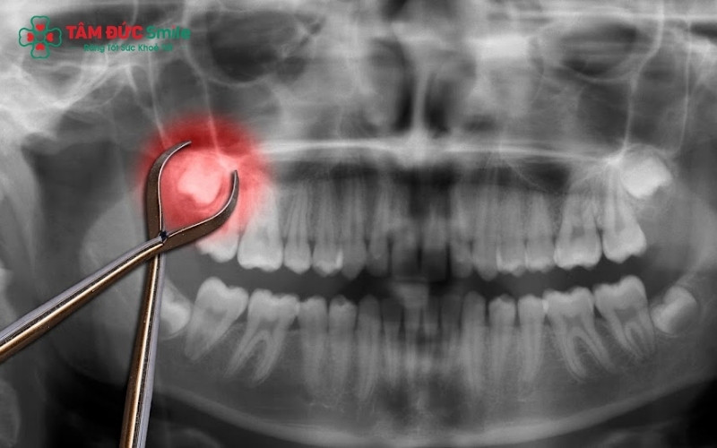 Đem đơn thuốc sau nhổ răng đến gặp bác sĩ sản khoa là việc làm cần thiết nhất để đảm bảo an toàn cho thai nhi.