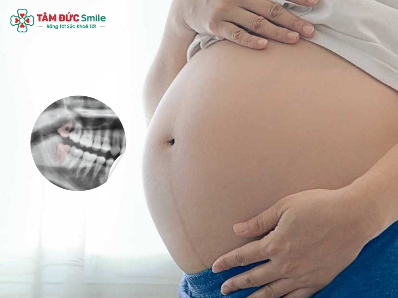 Không biết có thai đi nhổ răng khôn có sao không?