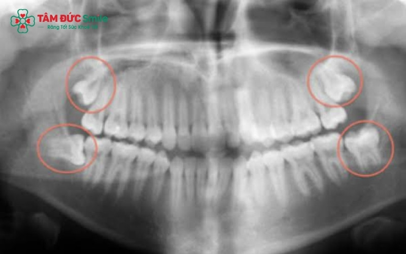 Chụp phim X-quang là bước quan trọng nhất giúp bác sĩ xác định vị trí dây thần kinh và độ khó của răng, đảm bảo ca nhổ diễn ra an toàn.