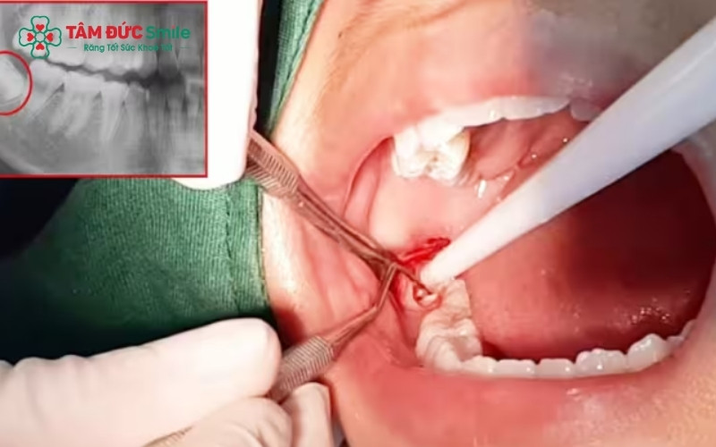 Công nghệ Piezotome sử dụng sóng siêu âm để tách răng ra khỏi xương hàm một cách nhẹ nhàng, giúp giảm sưng đau và chảy máu tối đa.