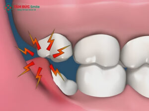 Kinh nghiệm nhổ răng khôn an toàn, ít đau và nhanh lành