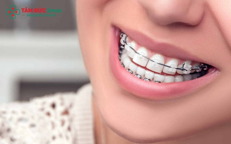 Niềng răng khi đã làm cầu sứ là hoàn toàn có thể, nhưng đây là một kỹ thuật phức tạp đòi hỏi bác sĩ phải tính toán lực dịch chuyển cho cả khối cầu răng