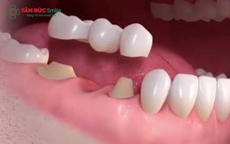 Cầu răng sứ thường có tuổi thọ trung bình từ 7 – 10 năm, thậm chí lâu hơn nếu người bệnh chọn chất liệu toàn sứ và có chế độ chăm sóc tốt.