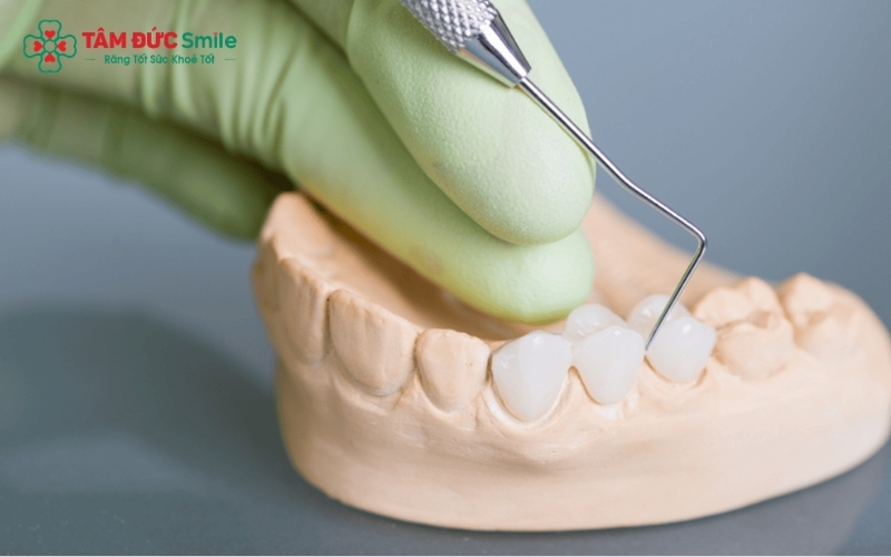Sức khỏe của hai răng trụ và chất liệu mão sứ là những yếu tố then chốt quyết định cầu răng có thể chịu được lực ăn nhai trong thời gian dài hay không.