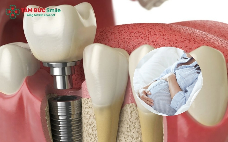 Các chuyên gia nha khoa thường khuyến cáo phụ nữ mang thai nên trì hoãn việc cấy ghép Implant cho đến sau khi sinh để tránh những tác động không đáng có