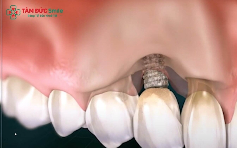 Quá trình cấy ghép Implant đòi hỏi chụp phim X-quang và sử dụng thuốc sau phẫu thuật, những yếu tố này tiềm ẩn nguy cơ đối với sự phát triển của thai nhi.