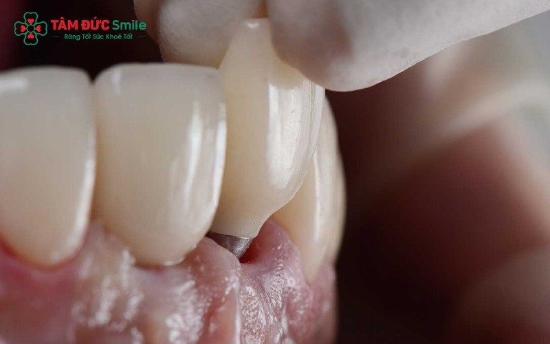 ếu mất răng trong thai kỳ, bác sĩ sẽ ưu tiên các biện pháp chăm sóc tại chỗ hoặc phục hình tạm thời để duy trì chức năng ăn nhai cho mẹ trước khi thực hiện Implant.