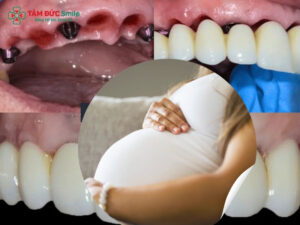 Mang thai có nên cấy ghép răng Implant không?