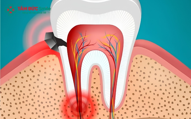 rám răng là giải pháp tối ưu cho các trường hợp sâu răng vừa và nhẹ, giúp loại bỏ ổ vi khuẩn và ngăn chặn sâu răng tái phát.