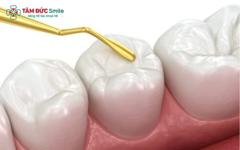 Các mẹo dân gian chỉ làm tê liệt dây thần kinh cảm giác tạm thời; nếu không điều trị tận gốc, vi khuẩn sẽ tiếp tục phá hủy tủy răng và gây biến chứng nguy hiểm.