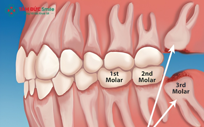 Mọc đầy đủ 4 chiếc răng khôn là tình trạng bình thường ở người trưởng thành, tuy nhiên đa số chúng thường không có đủ không gian để mọc thẳng hàng
